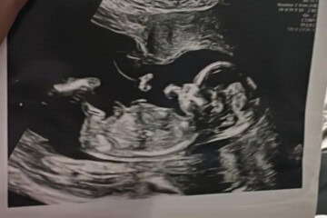 Baby scan